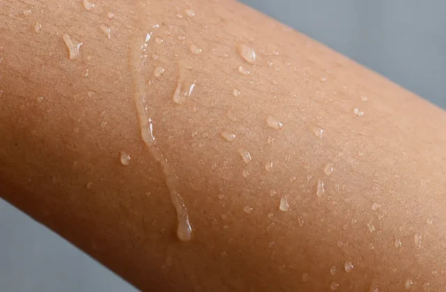 Allergie voor water: symptomen en behandeling