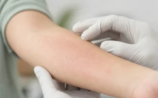 Hoe herken je een allergische reactie op de huid?